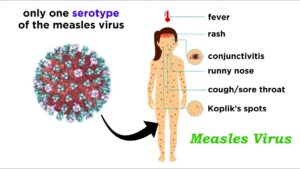 Measles Virus